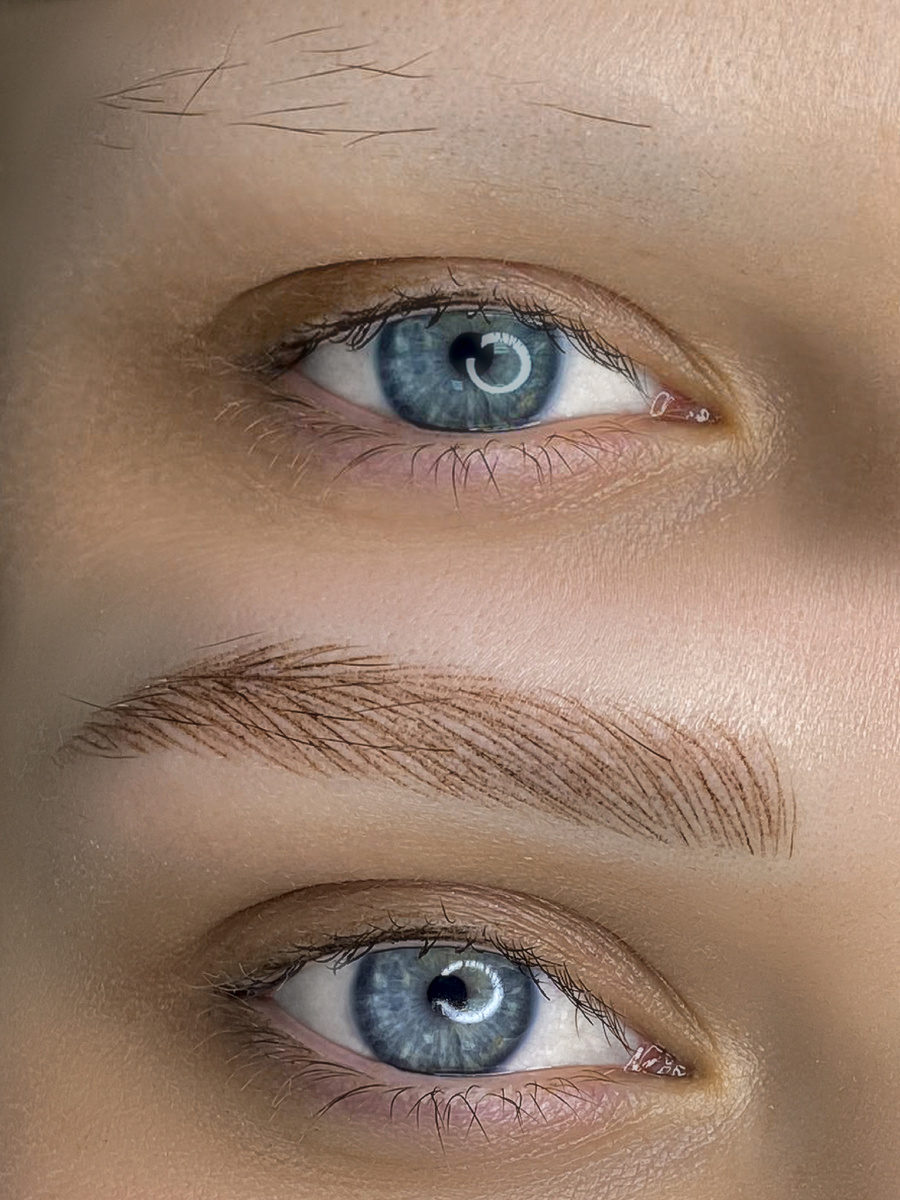 Очаговая алопеция до/после