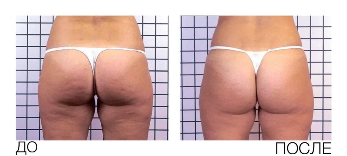 Результаты до/после процедуры Icoone Laser Med