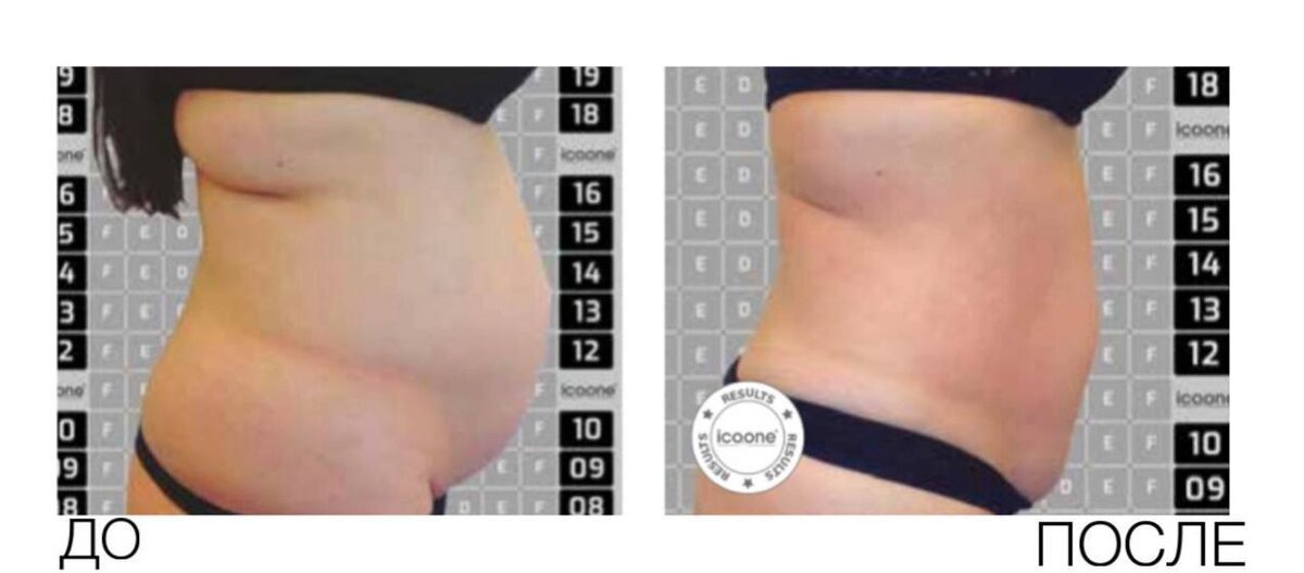 Результаты до/после процедуры Icoone Laser Med