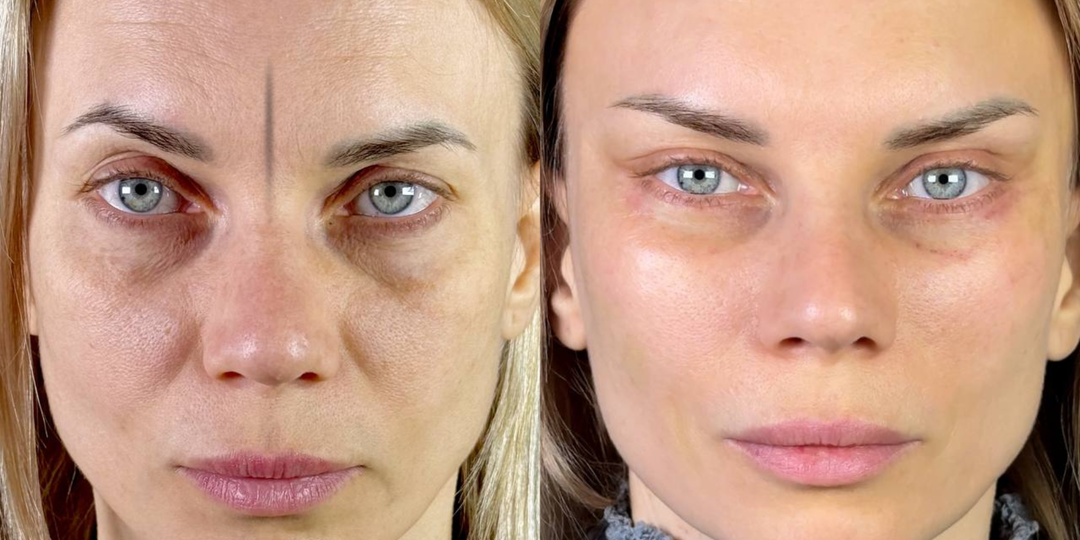 МЕЖБРОВНАЯ МОРЩИНА: почему она появляется раньше всех и как с ней бороться