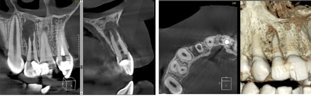Периодонтит и резорбция