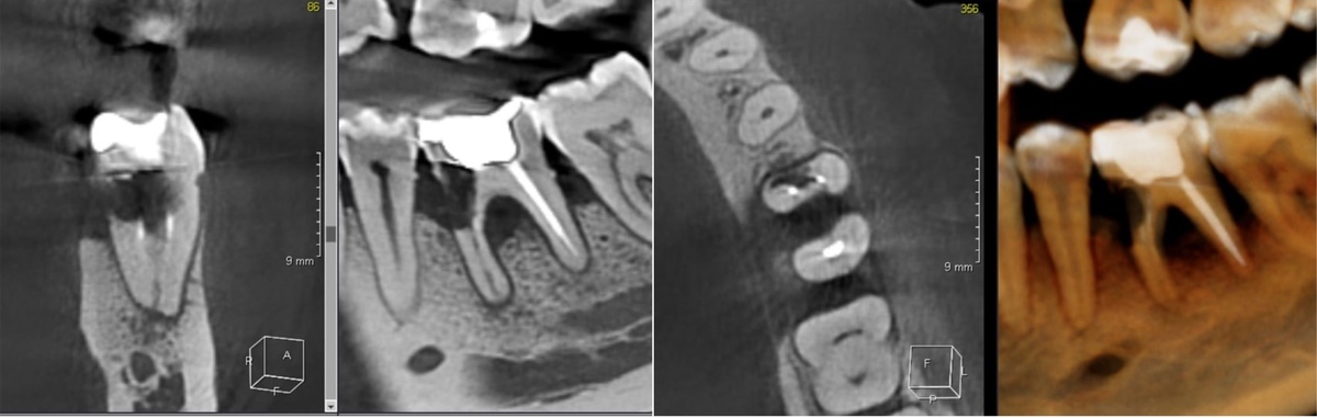 Цервикальная резорбция