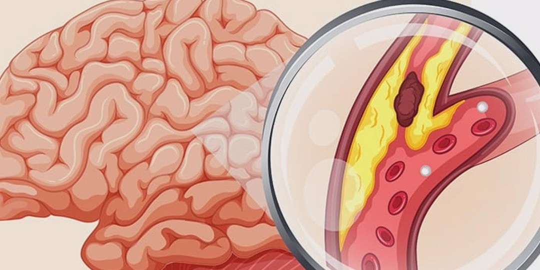 7 признаков, что сосуды мозга начинают сужаться
