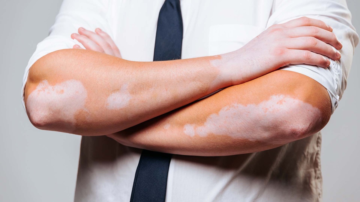 Таинственное витилиго: все, что вы должны знать об этом заболевании