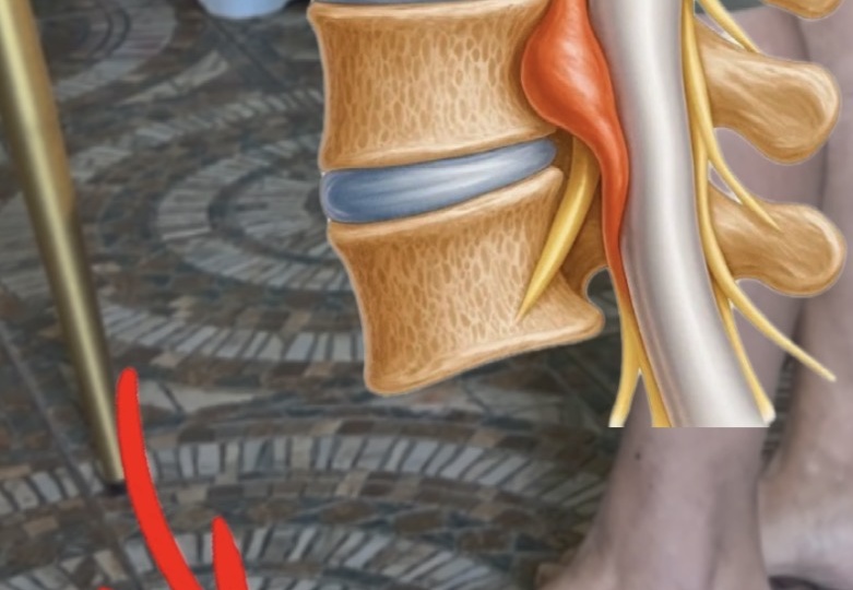Стеноз позвоночного канала: почему болит только одна нога и как проверить «затор» в спине