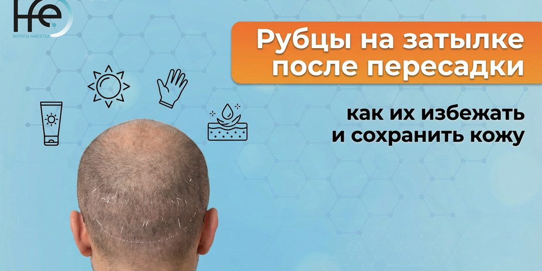 Рубцы на затылке после пересадки: как их избежать и сохранить кожу
