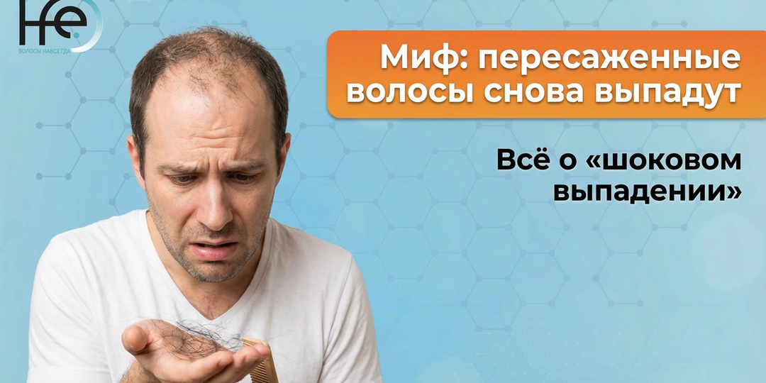 Миф: пересаженные волосы снова выпадут. Всё о «шоковом выпадении»