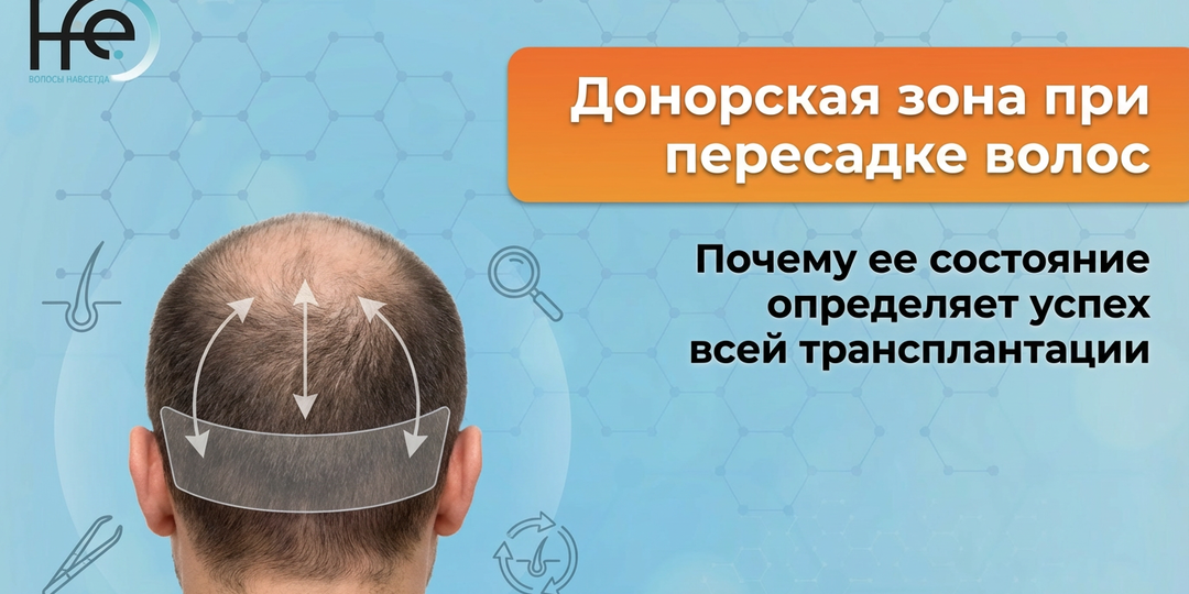 Донорская зона при пересадке волос: почему ее состояние определяет успех всей трансплантации