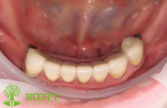 Пациент обратился с жалобами на отсутствие жевательных зубов и подвижность опорных зубов над протезом на нижней челюсти. 