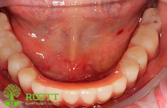 Была проведена имплантация с одновременным удалением подвижных зубов. На 3-й день установлен протез на винтовой фиксации. Полностью восстановлена жевательная функция и эстетика. 