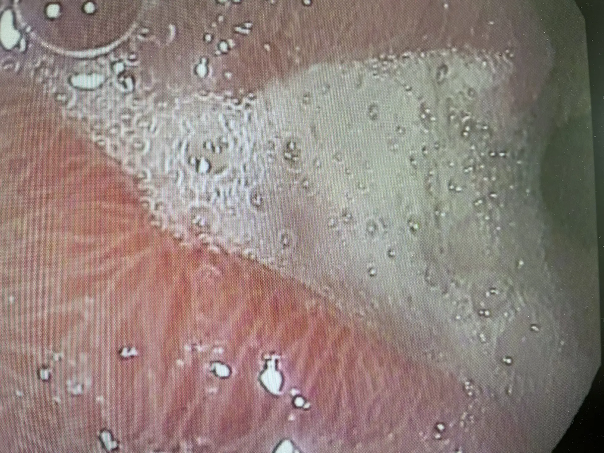 Язва желудка с подозрением на рак