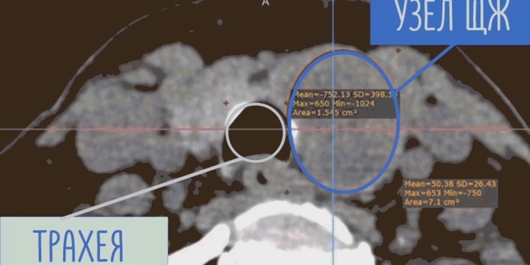 Дискомфорт в шее: когда причина не в щитовидной железе