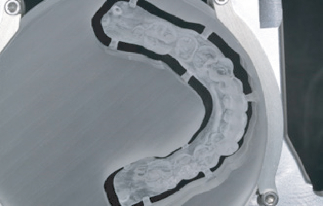 Рис. 1-2 Спроектированный цифровым способом и выточенный направляющий шаблон, окклюзионная поверхность и поверхность инталии