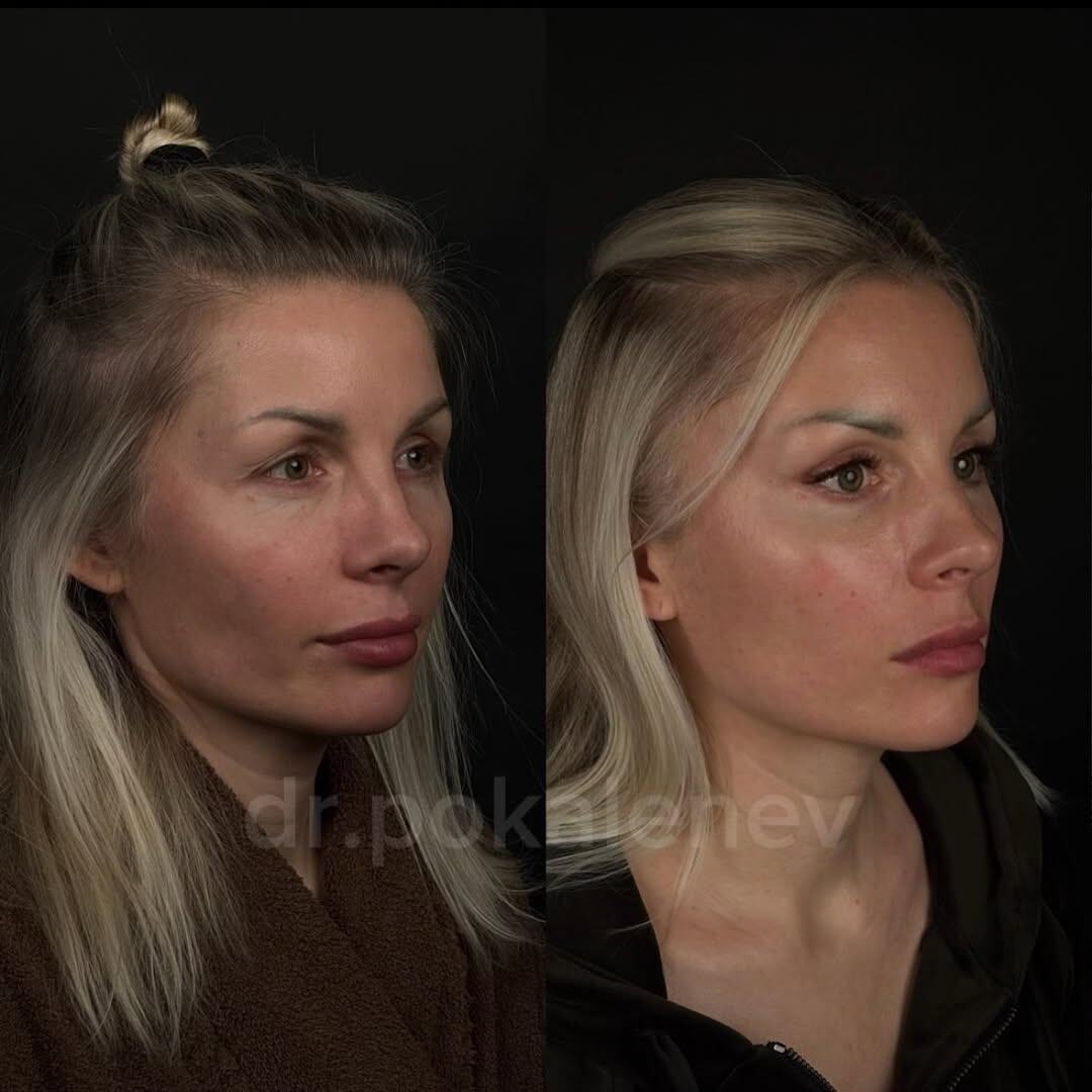 работа пластического хирурга клиники Форма Покаленьева Н.С. (височный лифтинг с проработкой средней зоны и круговая блефаропластика)