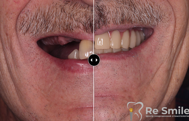 Пациент обратился с жалобами на частичное отсутствие зубов, их подвижность и неудовлетворительный эстетический вид на верхней и нижней челюстях.

Было проведено удаление оставшихся зубов на обеих челюстях с одновременной установкой дентальных имплантатов по одноэтапному протоколу. На 4-й день после операции выполнена фиксация условно-съемных адаптационных протезов на верхнюю и нижнюю челюсти.