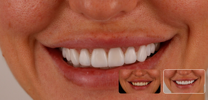 Комплексная реставрация винирами E-max на верхней и нижней челюсти