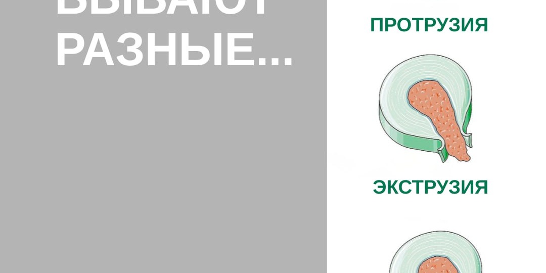 Слово «грыжа» в кабинете врача звучит не очень приятно