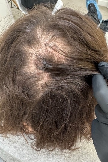 Как остановить выпадение волос и восстановить рост без операций