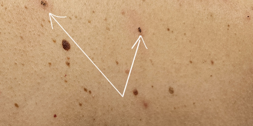 Этот сигнал организма может быть связан с новообразованиями