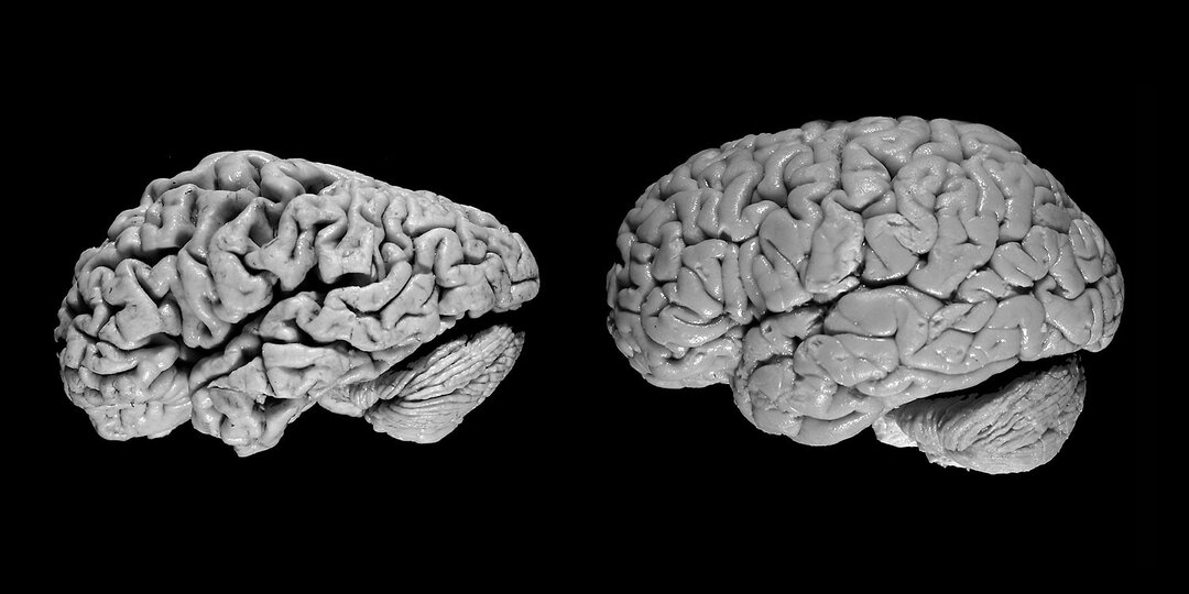 Врачи назвали сигнал, который может говорить о проблемах с мозгом