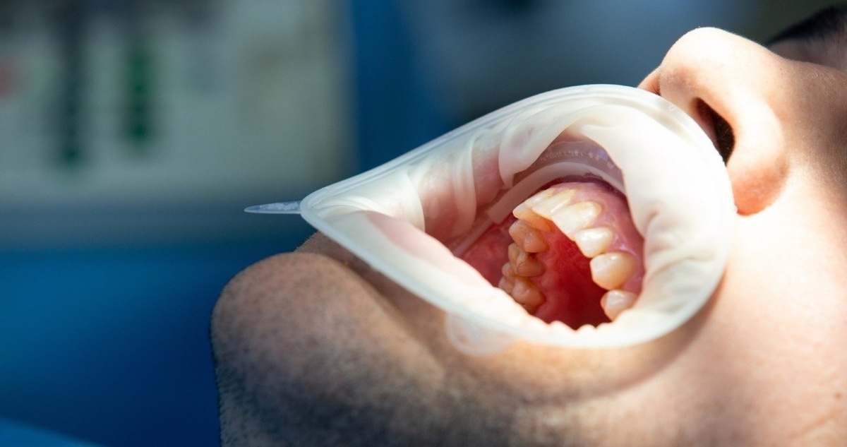 Удаление зубов мудрости в Екатеринбурге