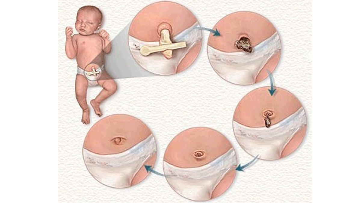 пупок новорождённого