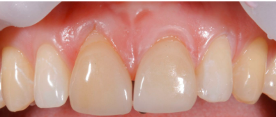 Рецессия десны, оголённые шейки зубов