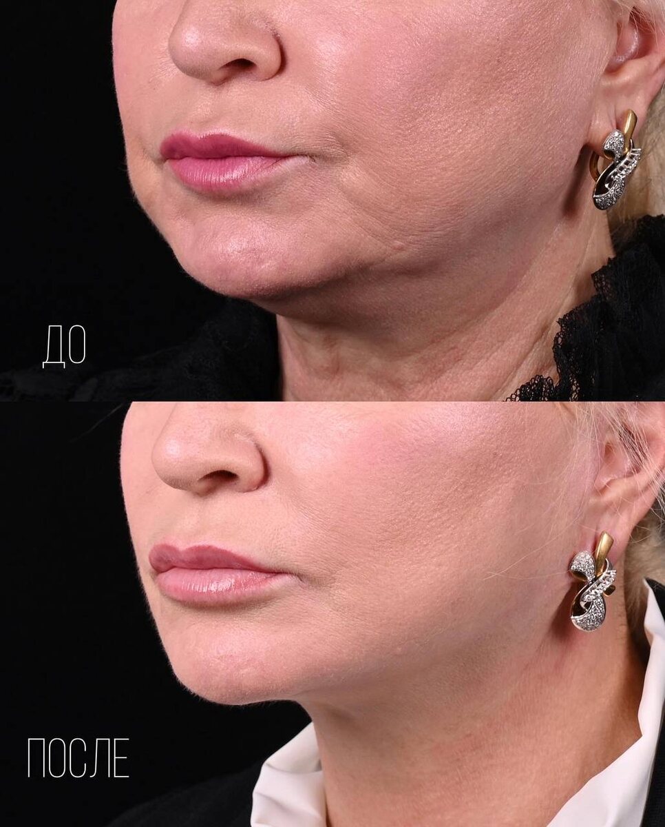 Липосакция подбородка. Фото до и после. Фото с сайта хирурга Д.Р. Гришкяна. Имеются противопоказания, требуется консультация специалиста.