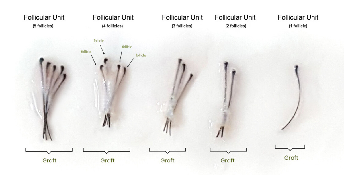 Изображение: схема графта с 1, 2, 3, 4 и 5 волосами