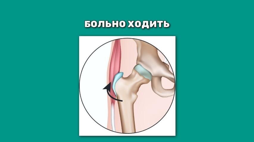 Почему болит нога в бедре при ходьбе
