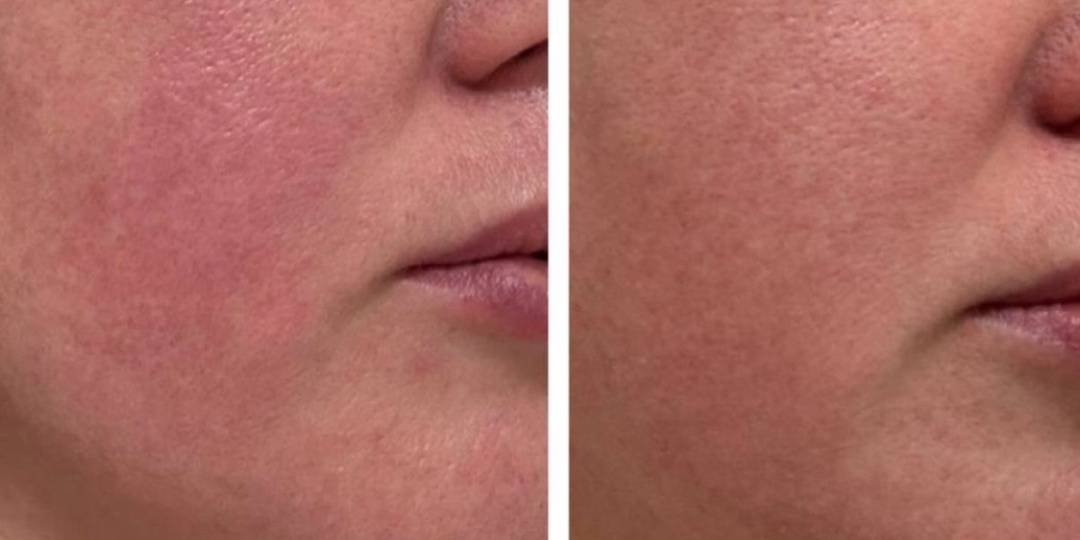 История одной чувствительной кожи моего клиента