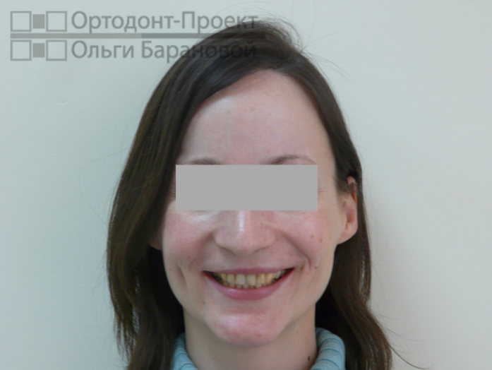 Фотометрия до лечения