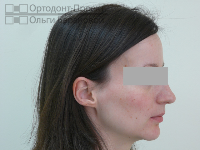 Фотометрия до лечения