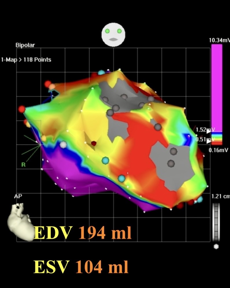 Электрофизиология сердца. Розовый цвет - нормальный миокард, серо-красно-желто-зелено-голубой - пораженная инфарктом область сердца 