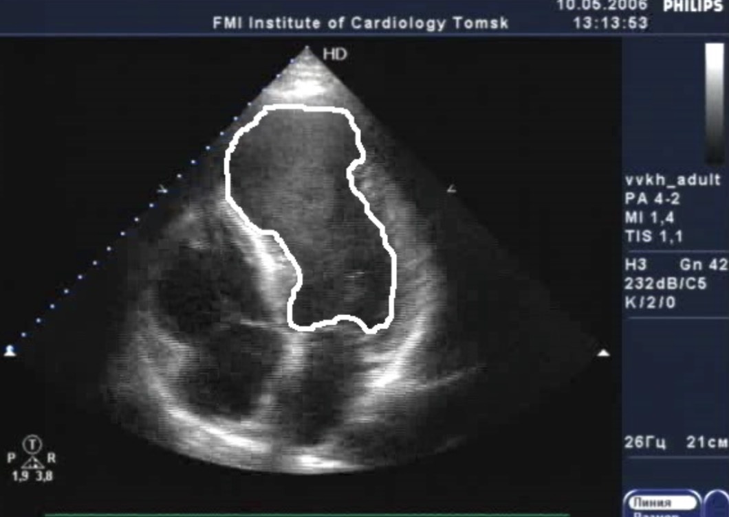 УЗИ сердца с аневризмой