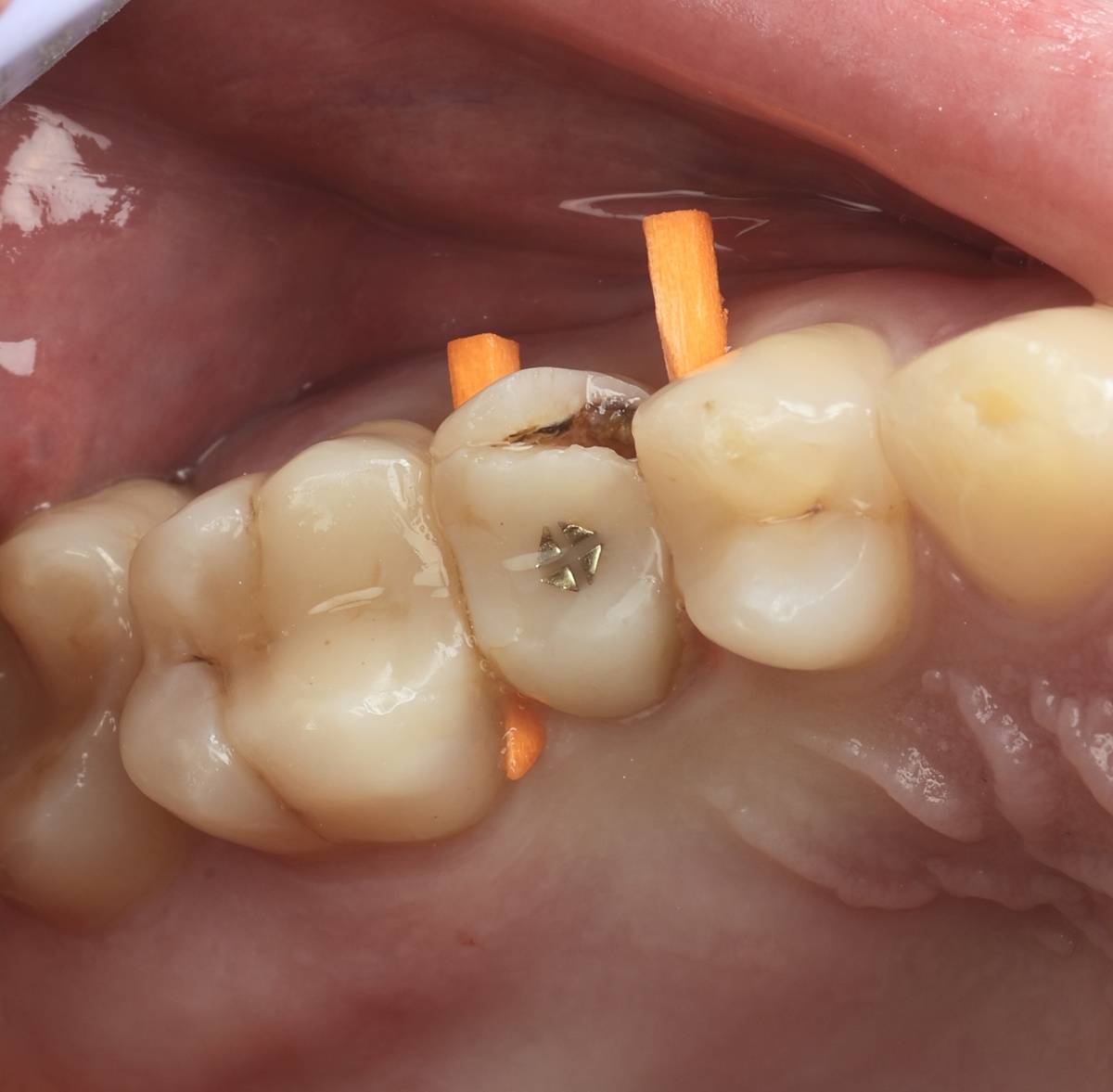 Зуб 2.5 до лечения