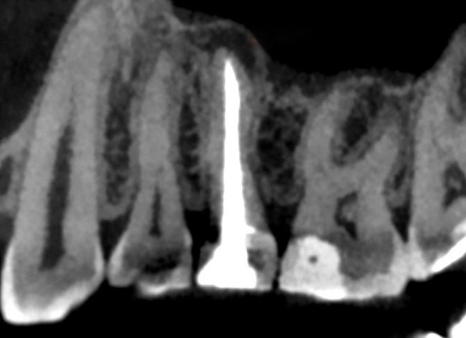 КТ до, периодонт