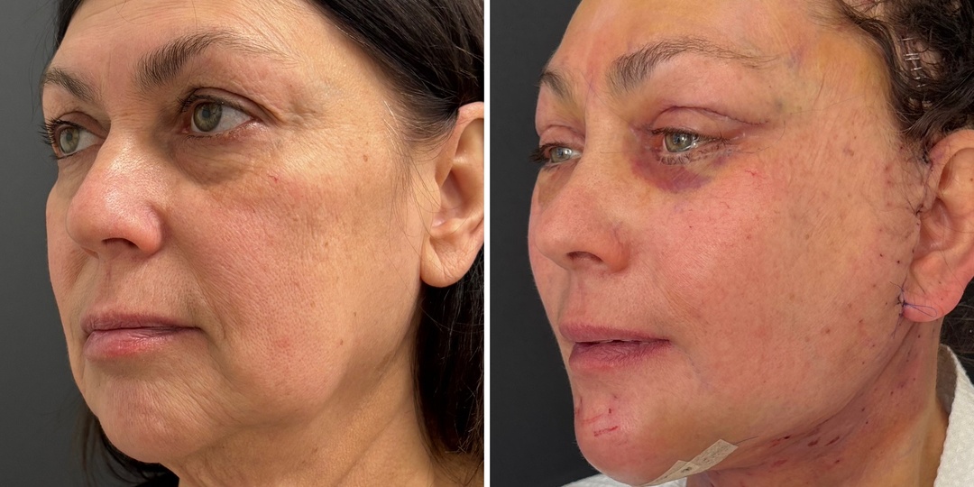 Фейслифтинг, эндоскопическое омоложение, платизмопластика, блефаропластика: 2-е сутки после операции