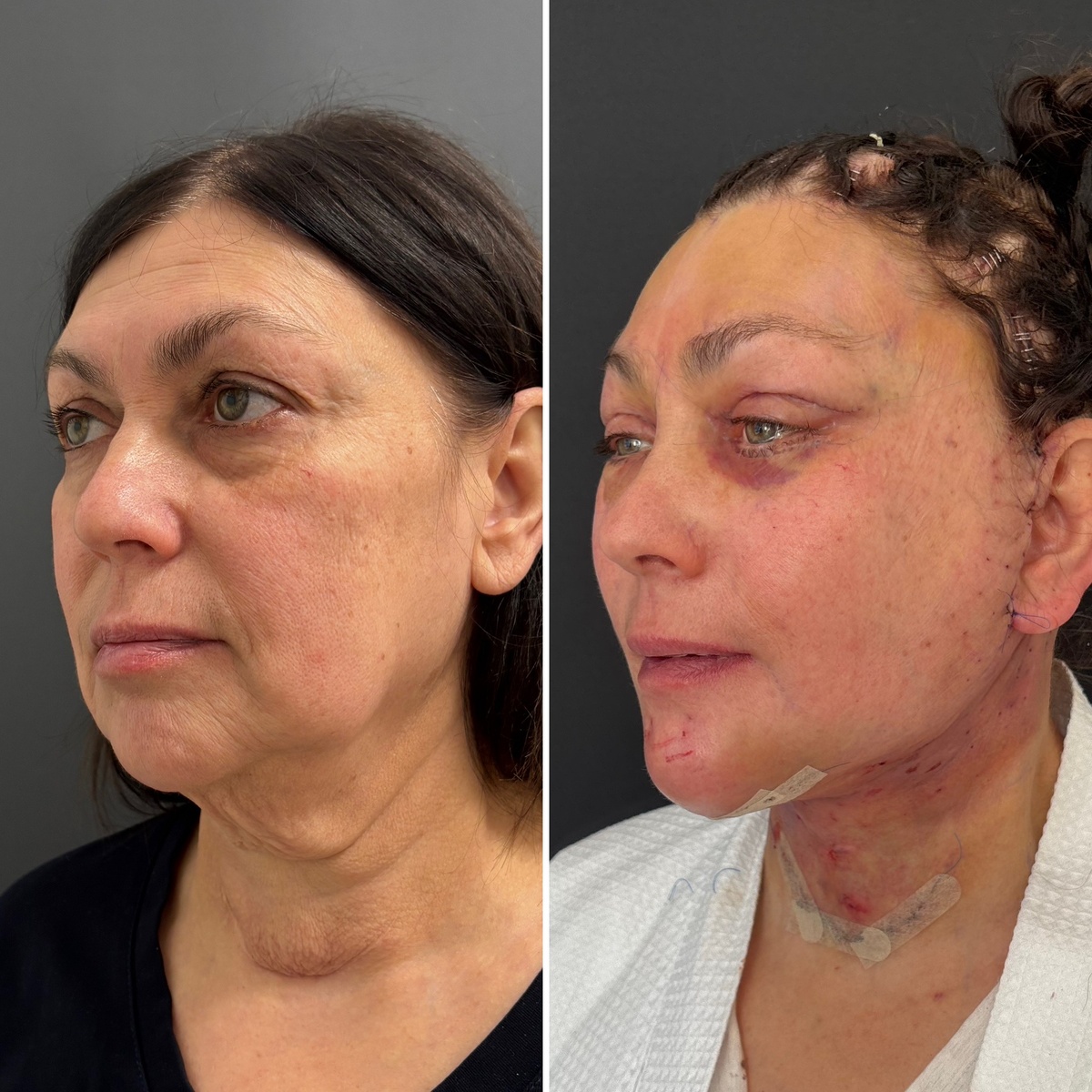 Комплексное омоложение лица: 2-е сутки после операции. Пластический хирург к.м.н. Остринская Т. В.