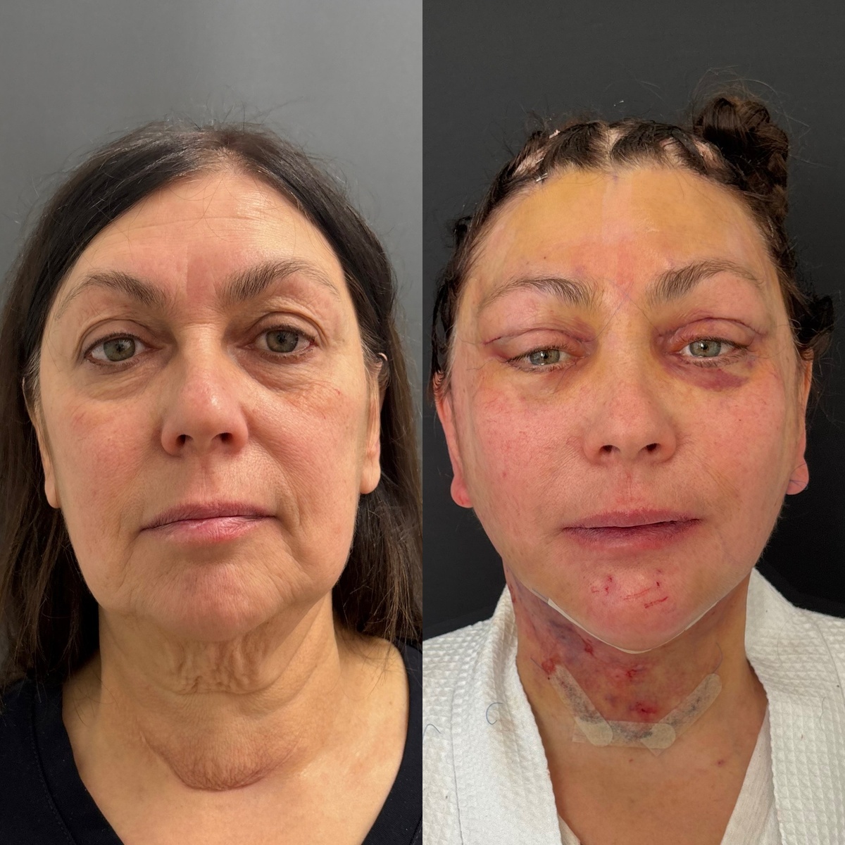 Комплексное омоложение лица: 2-е сутки после операции. Пластический хирург к.м.н. Остринская Т. В.