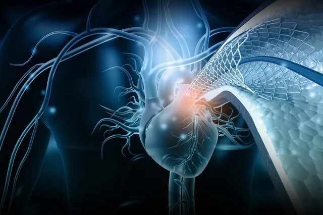    Что такое аортальный стеноз?