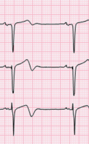 Небольшое повышение сегмента ST в правых грудных отведениях, инверсия зубца Т. Изменения "не тянут" на крупноочаговый инфаркт. Но при этом довольно часто на коронарографии регистрируется окклюзия или субокклюзия передней межжелудочковой артерии.