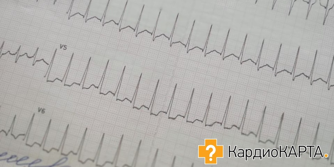 Фибрилляция предсердий: история одного сердца, или как договориться с аритмией, когда операция под запретом