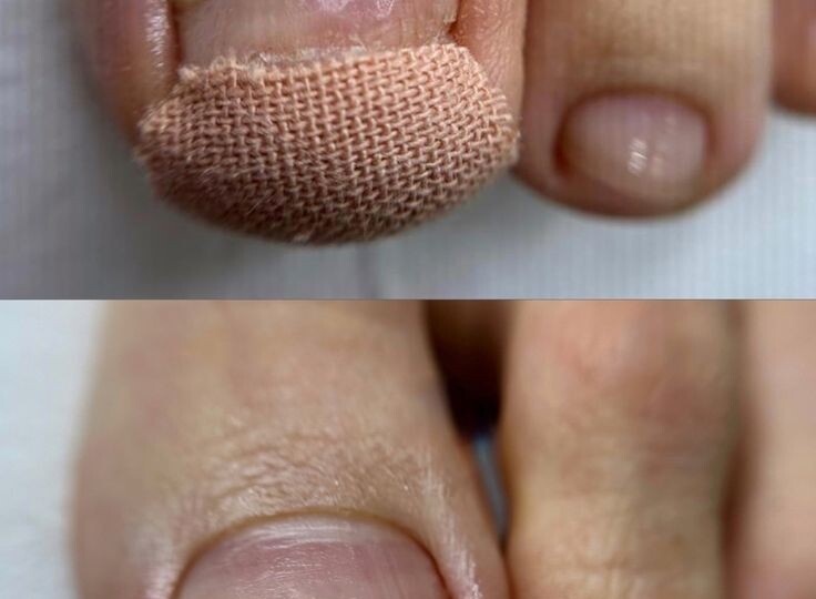 Ортониксия как спасение: преимущества систем «Титановая нить» и «З-ТО» в центре подологии «Альба»