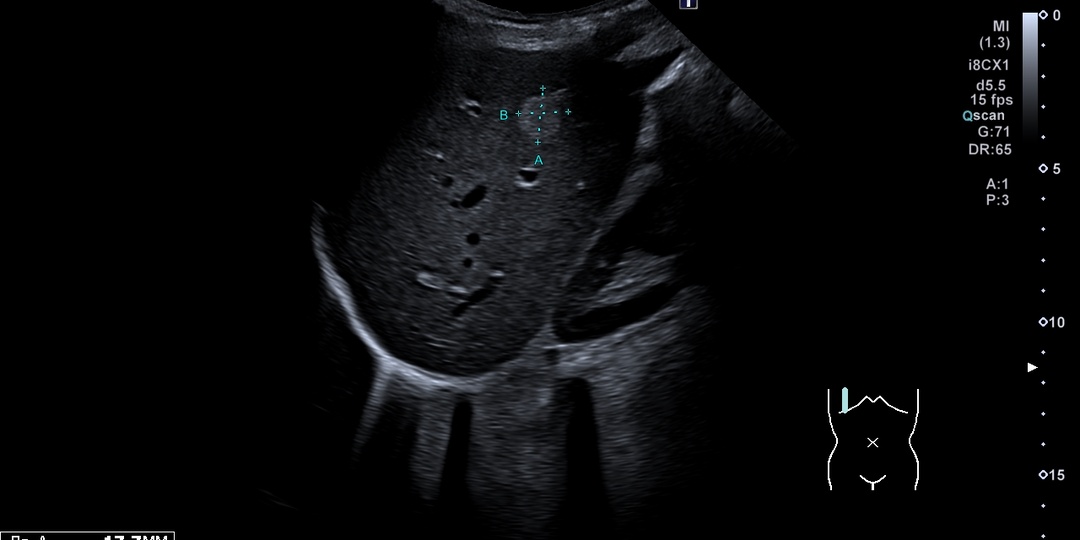 Откуда берутся гемангиомы печени у людей?