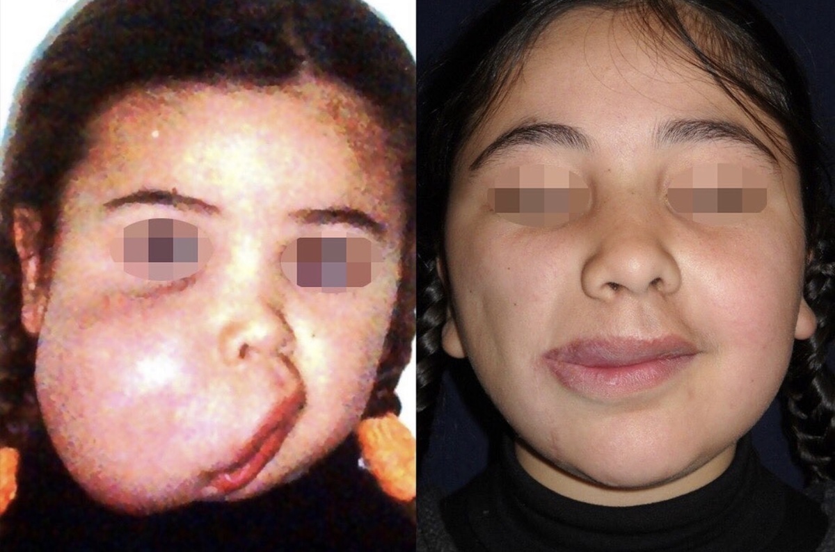 Удаление раковой опухоли