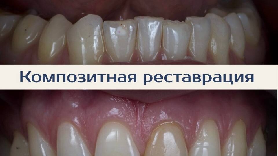 Скол переднего зуба: восстановили форму и эстетику