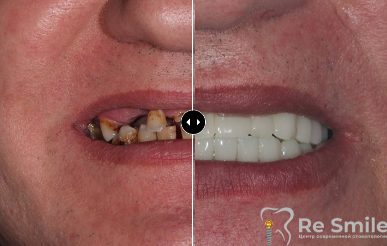 Пациент обратился с жалобами на полное отсутствие зубов. Была проведена комплексная дентальная имплантация по протоколу «all-on-8» на обеих челюстях с немедленной нагрузкой металлопластмассовыми мостовидными протезами.