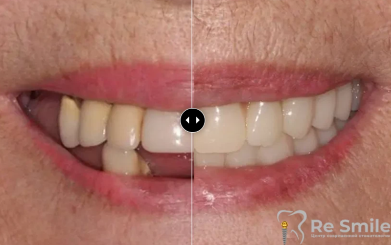 Пациентка обратилась с жалобами на частичное отсутствие зубов и неудовлетворительную эстетику.

Было проведено снятие металлокерамических конструкций, удаление несостоятельных зубов и корней на верхней и нижней челюстях с одномоментной имплантацией "all on 8" на верхней челюсти и "all on 8" на нижней челюсти с немедленной нагрузкой металлопластиковыми протезами на верхней и нижней челюстях.