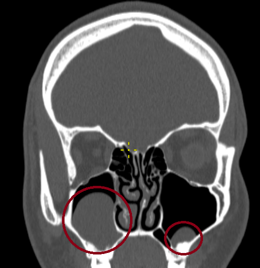 Довольно крупная (на картинке слева) и мелкая (справа) кисты гайморовых пазух на компьютерной томографии (КТ). Удаление в данном случае не требовалось.